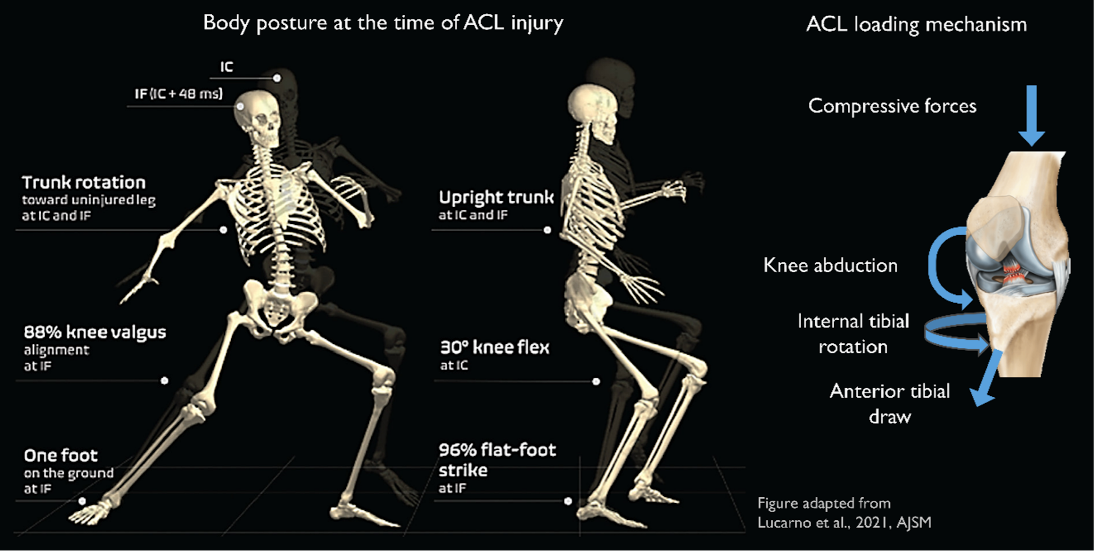 그림 1. 전방 십자인대 (ACL) 손상에 기여하는 운동역학적 요인. Lucarno 및 다른 연구(2021년)에서 적용된 그림.